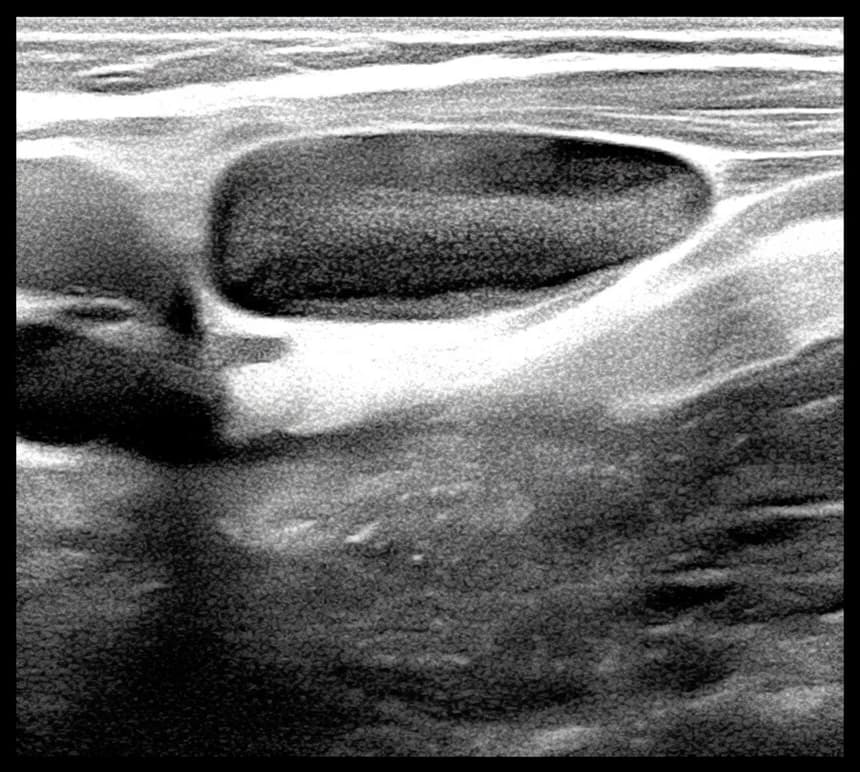 Ultrassom em escala de cinza mostrando uma formação oval anecoica na região cervical de uma criança.