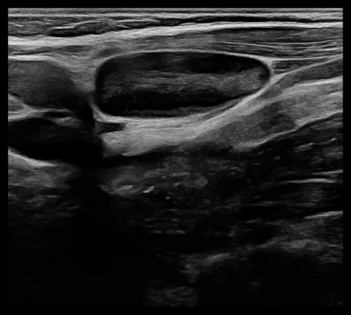 Mesmo ultrassom cervical com ganho e janela ajustados, mostrando a lesão com contornos mais definidos.