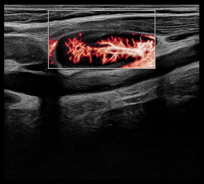 Ultrassom com Doppler colorido mostrando fluxo vascular ramificado a partir do hilo do linfonodo.